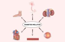 Diabetes mellitus Fettsucht: krank durch zu viel Gewicht