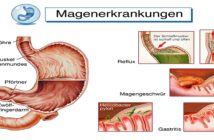 Lymphozytäre Gastritis: Hilfe für den Magen