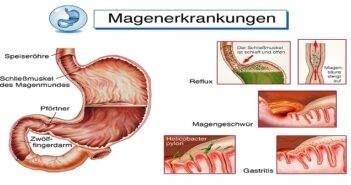 Lymphozytäre Gastritis: Hilfe für den Magen