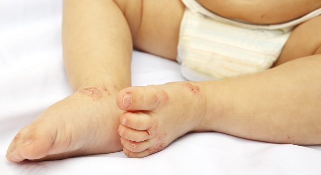 Schon Babys können diese Hand-Fuß- Mundkrankheit bekommen.