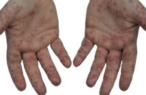 Hand-Fuß-Mund-Krankheit: Definition, Symptome, Therapie