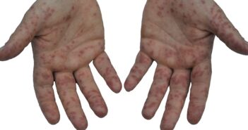 Hand-Fuß-Mund-Krankheit: Definition, Symptome, Therapie