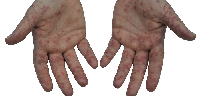 Hand-Fuß-Mund-Krankheit: Definition, Symptome, Therapie