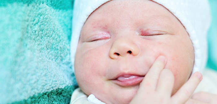 Babyakne: Ursachen und Tipps für den Umgang mit Akne bei Babys