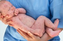 Herpes bei Kindern: Ursachen, Symptome, Behandlung