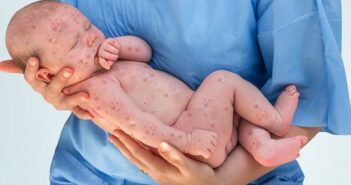 Herpes bei Kindern: Ursachen, Symptome, Behandlung