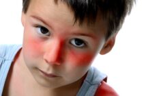 Sonnenbrand bei Kindern: Was tun?