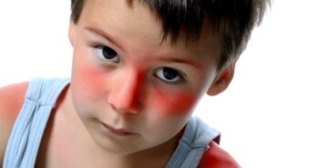 Sonnenbrand bei Kindern: Was tun?