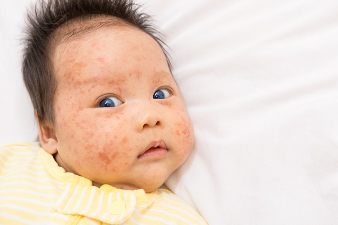 Auch bei Babys treten Hautkrankheiten und -unreinheiten auf, die in vielen Fällen aber unbedenklich sind. (#04)