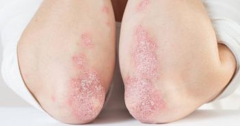 Schwangerschaft und Psoriasis: Herausforderung und Behandlungsoptionen für (Foto: AdobeStock 332799872  SNAB)